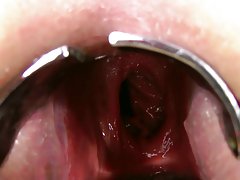 kinkyniky dvigubas analinis fisting prolapsas xo reflektorius žiopsojimas